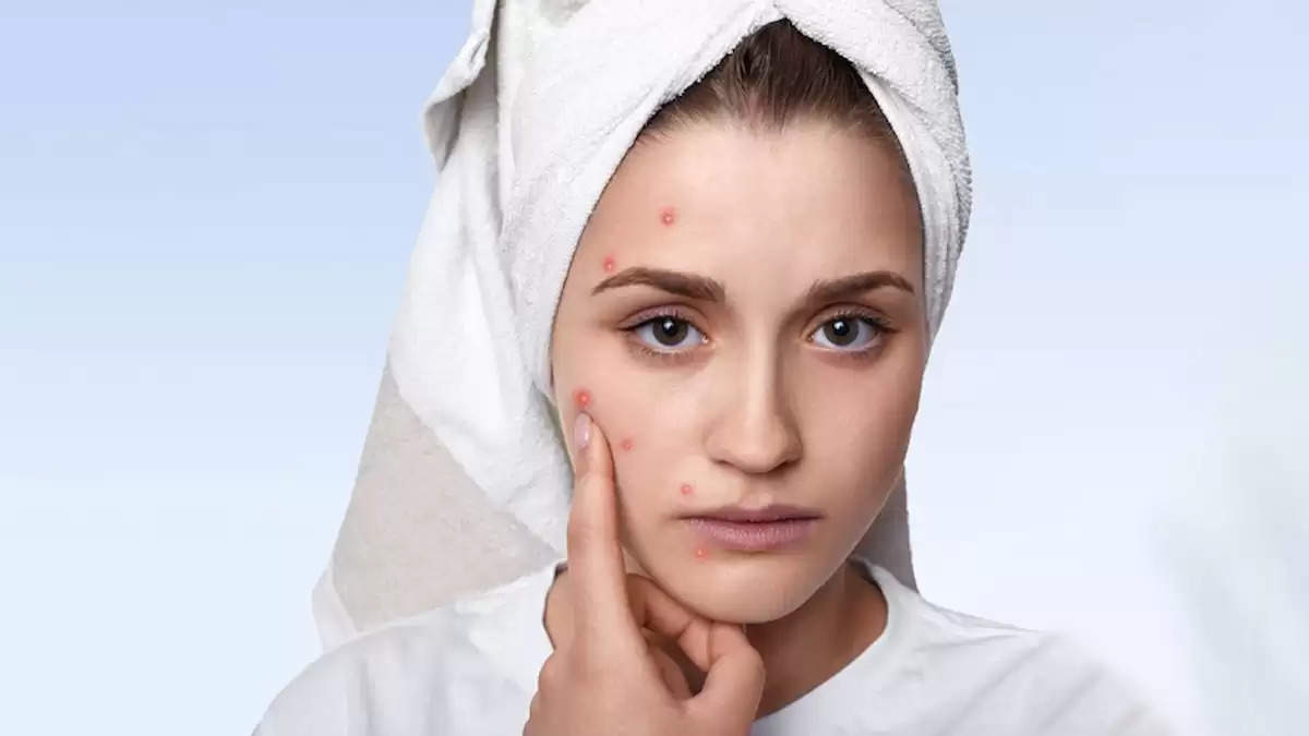 Tips To Hide Pimples Without Makeup Pimples Can Be Hidden Even 