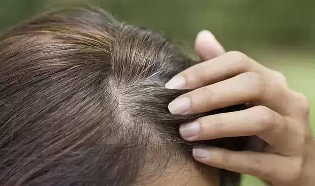 White Hair 10 Causes Prevention and Home Remedies