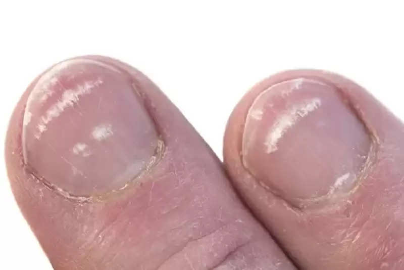 white-spot-on-nails-these-marks-of-nails-tell-your-character-and