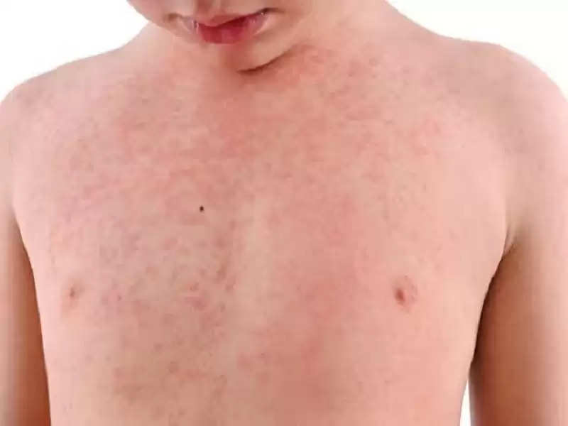 health-heat-rash-has-troubled-children-in-summer-so-these-home