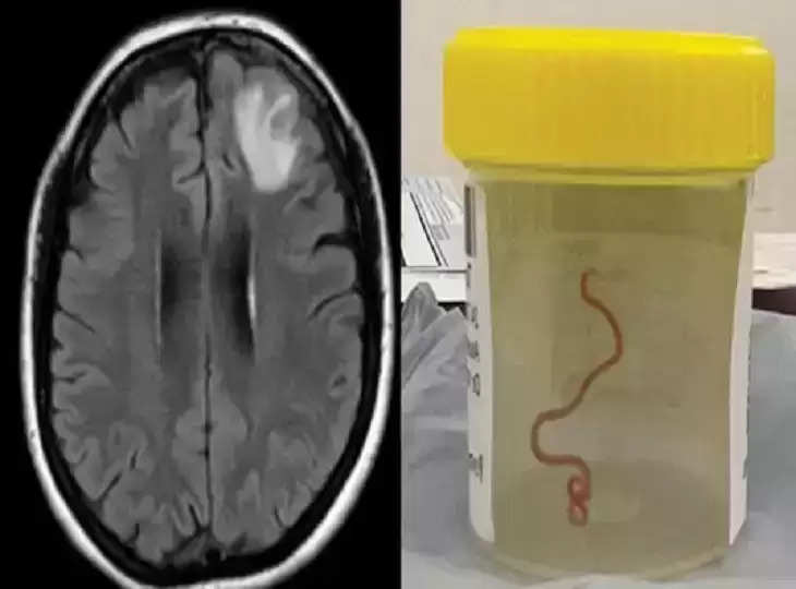 Omg Live Worm Found In Pythons Found In Woman S Brain