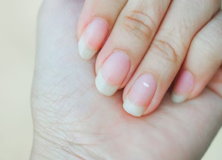 white-spots-on-nails-why-do-white-spots-appear-on-nails-would-be