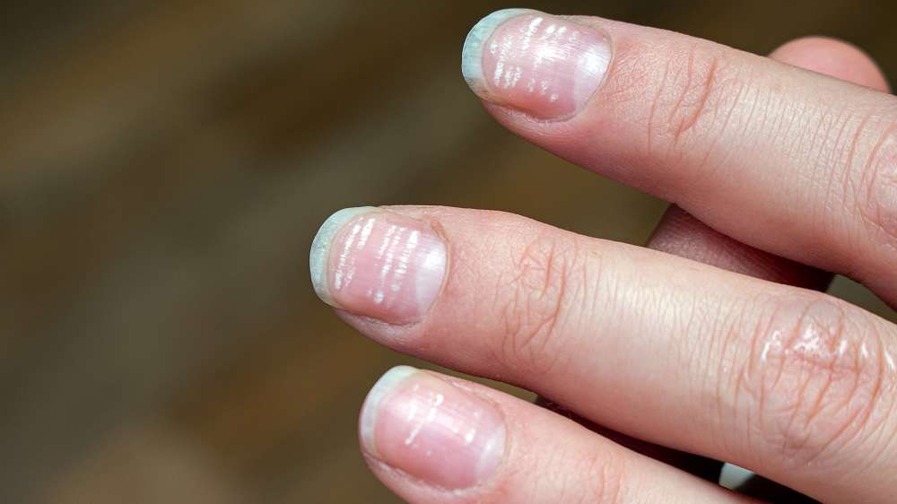 white-spot-on-nails-these-marks-of-nails-tell-your-character-and