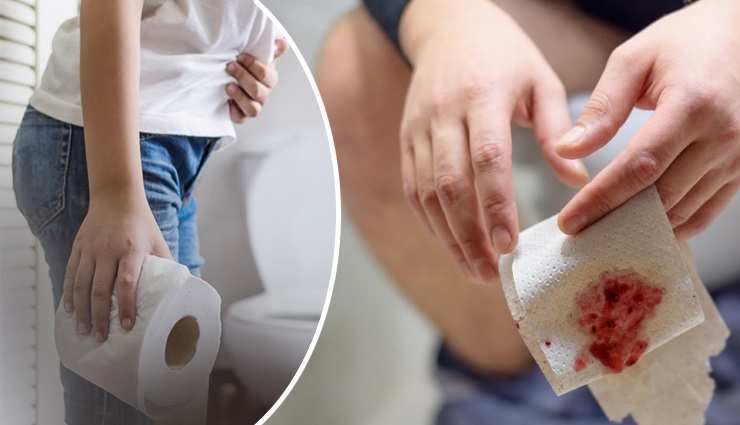 Constipation is the main cause of piles, use these things to keep your ...